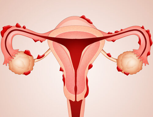 Conférence : Kinésithérapie et infertilité dans le contexte de l’endométriose